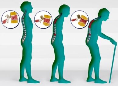 Остеопороза